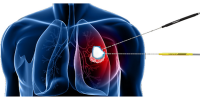 Η διαδερμική κρυοθεραπεία (CRYOABLATION)  στην αντιμετώπιση του καρκίνου