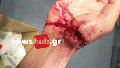 ΑΠΟΚΛΕΙΣΤΙΚΟ: Άγρια επίθεση σε ζευγάρι από πιτμπουλ στο Ηράκλειο, ενώ έκαναν βόλτα (Προσοχή, σκληρές εικόνες)