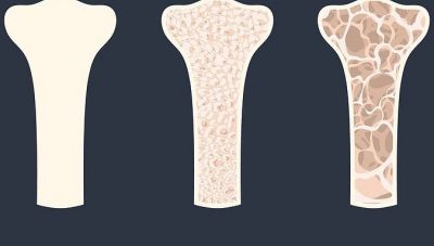 Δράση προληπτικού ελέγχου για την οστεοπόρωση από τον Δήμο Ηρακλείου