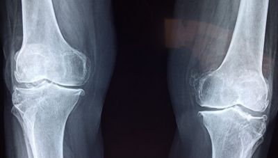 Η τεχνητή νοημοσύνη αλλάζει και την ορθοπεδική