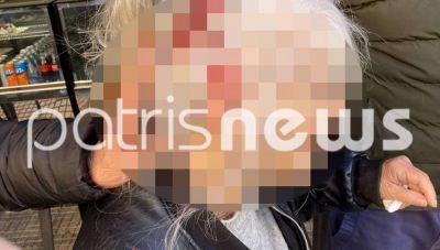 Πύργος: Λήστεψαν γυναίκα μέρα-μεσημέρι και την έστειλαν στο νοσοκομείο