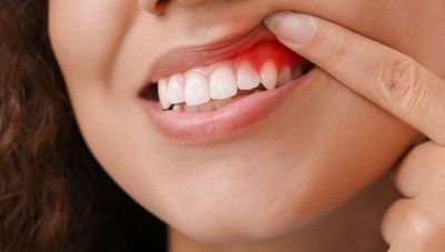 Η μεσογειακή διατροφή μπορεί να μειώσει την ουλίτιδα