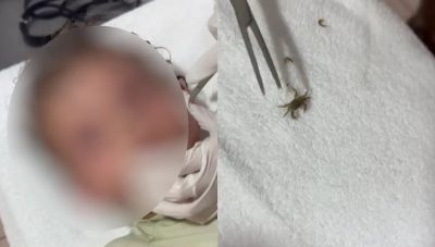Καβούρι μπήκε στο αυτί ενός αγοριού στο Μεξικό: Βίντεο από τη στιγμή που οι γιατροί το βγάζουν ζωντανό
