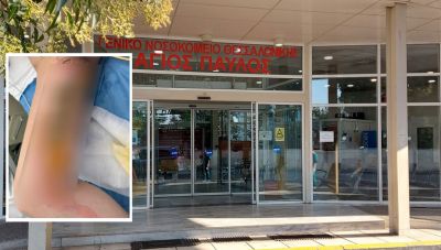 Εφιάλτης για 20χρονη στη Θεσσαλονίκη: Μπήκε στο νοσοκομείο για αφαίρεση κύστης κόκκυγα και κατέληξε με εγκαύματα τρίτου βαθμού